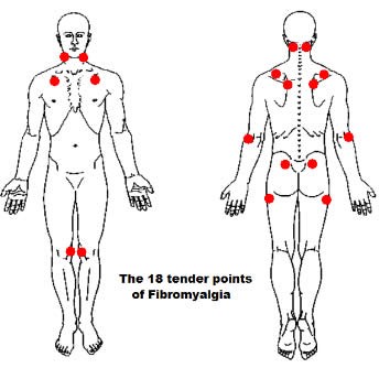 Fibromialgia: nuove linee guida